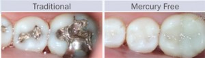 Traditional vs Mercury Free Fillings